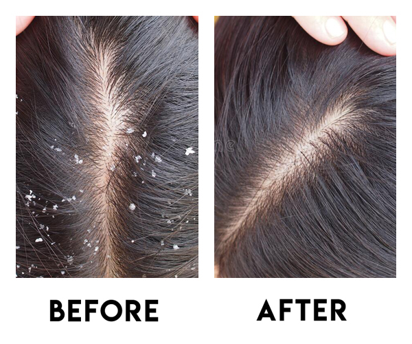 Dandruff Treatment at Home in Pakistan (Permanent Solution)