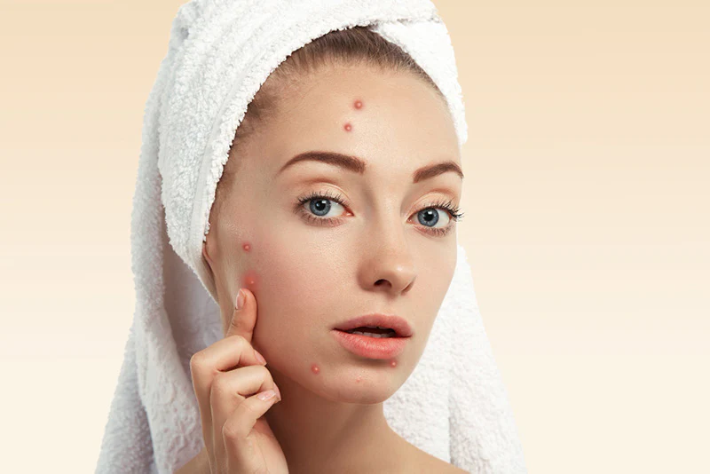 Home Remedies for Acne and Pimples in Pakistan (Clear Skin Tips That Actually Work)