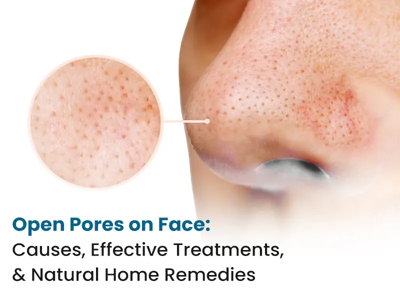 Woman with visible open pores on face before skincare treatment