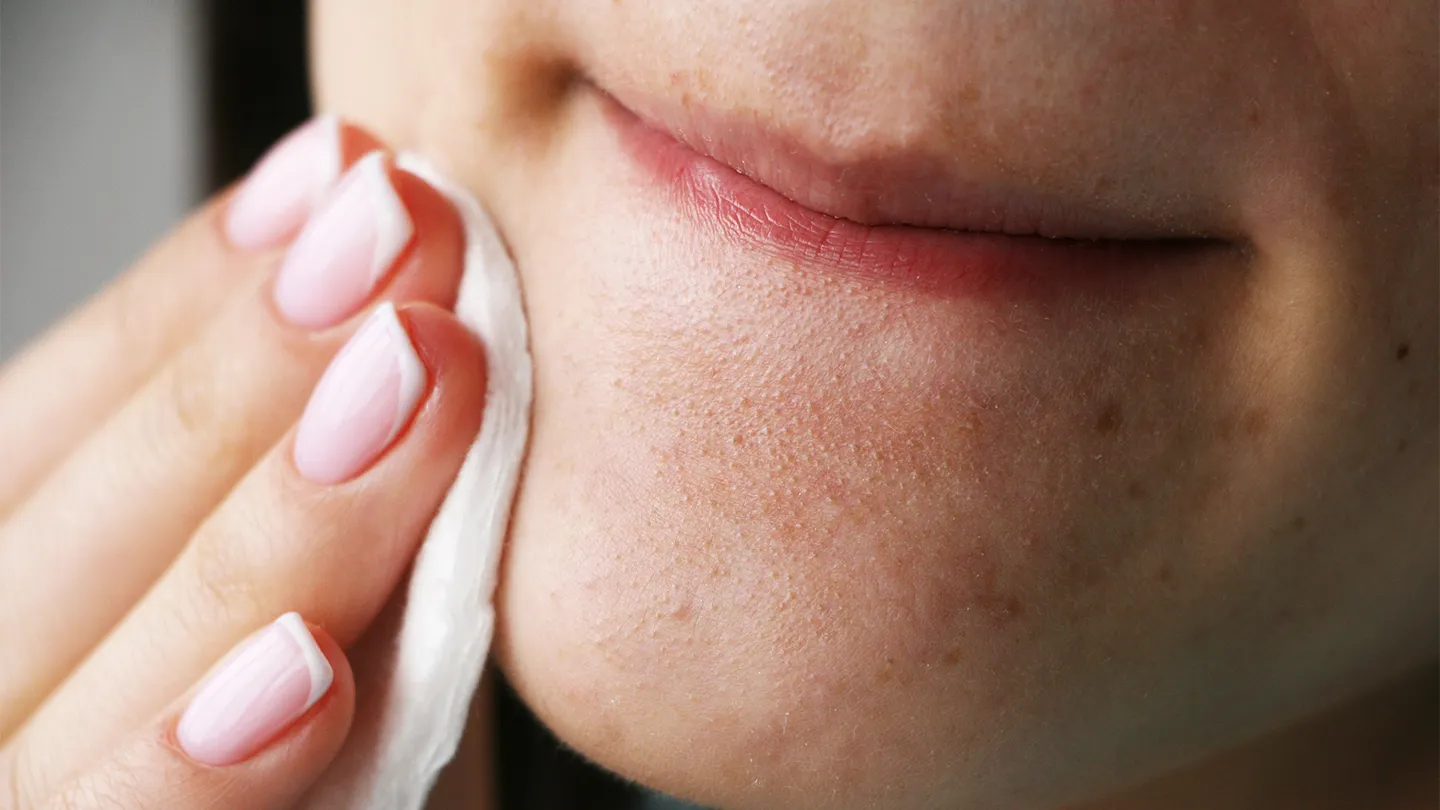 Honey and lemon face mask for blackheads treatment