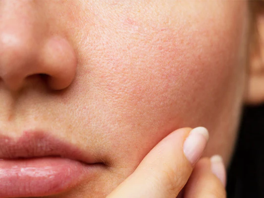 Natural remedies for open pores and smooth skin