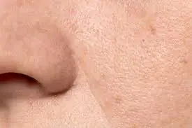ice cube therapy for open pores treatment at home ice cube therapy for open pores treatment at home
