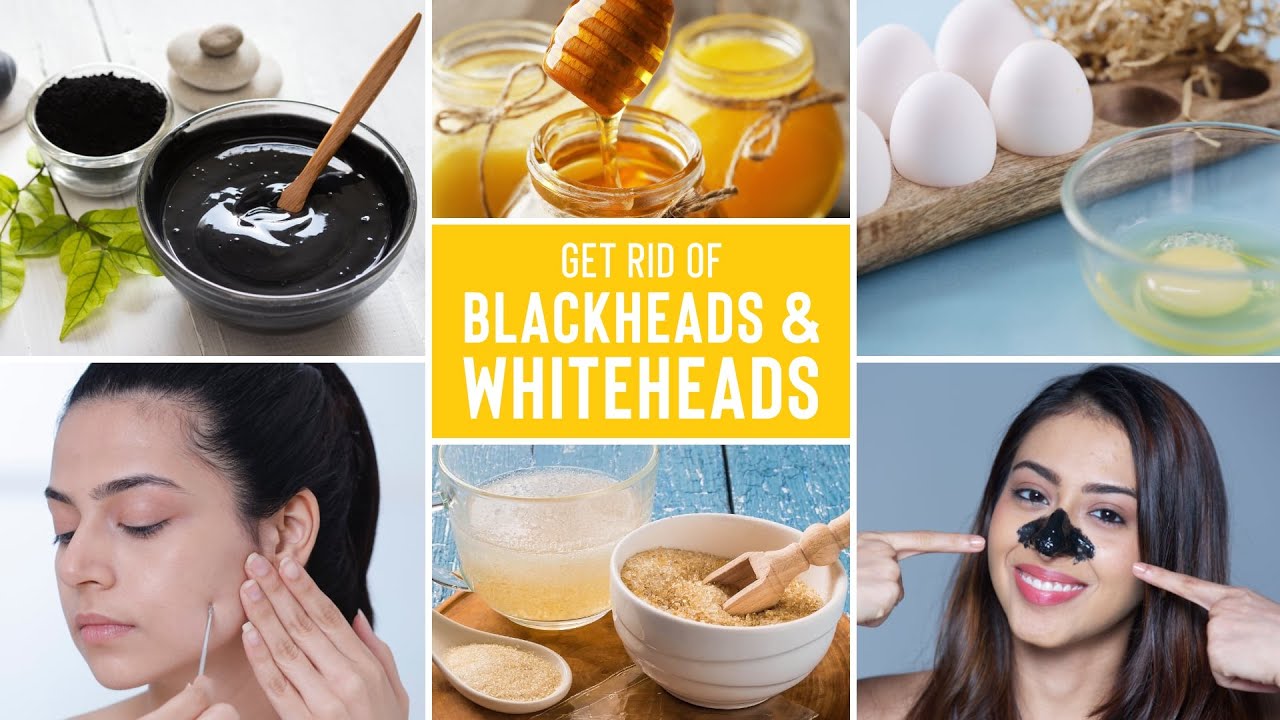 Honey and lemon face mask for blackheads treatment