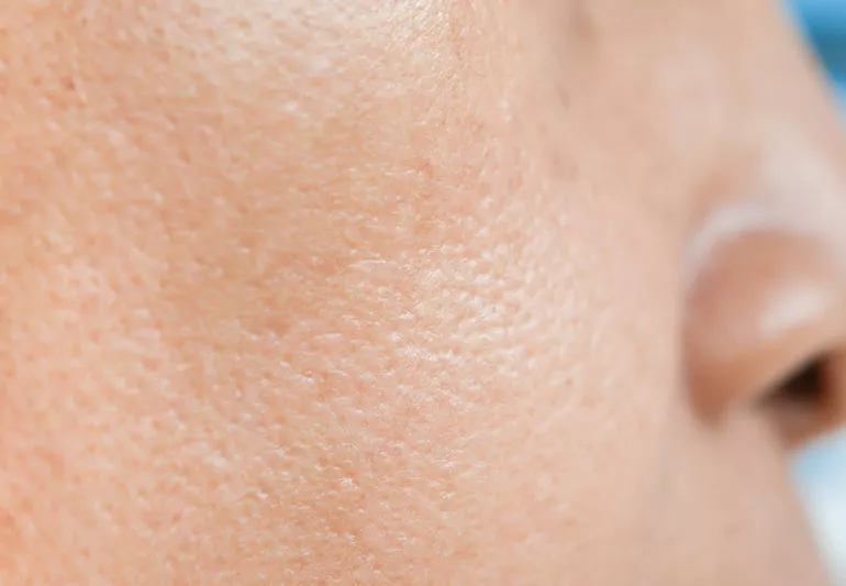 Woman following summer skincare routine to prevent open pores.