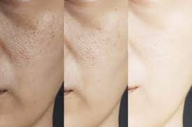 Natural ways to tighten skin pores fast at home