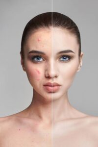 images - 2026-06-30T171144.833 Open pores vs acne scars comparison on facial skin