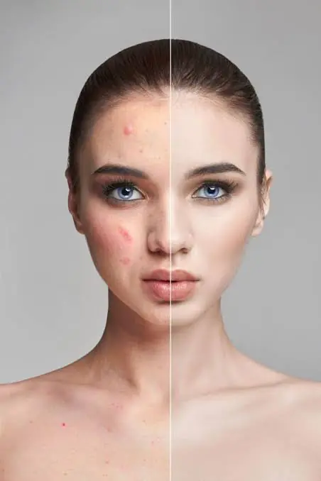 Open pores vs acne scars comparison on facial skin