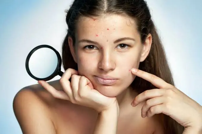 Open pores vs acne scars comparison on facial skin