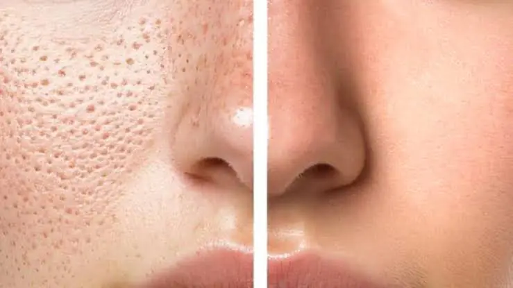 Woman checking enlarged pores in mirror