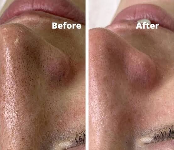 Woman applying aloe vera gel as an overnight remedy for open pores.